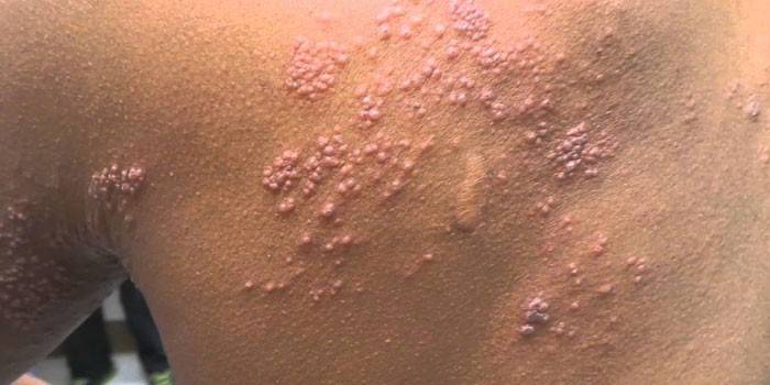 Von Herpes zoster betroffene Haut