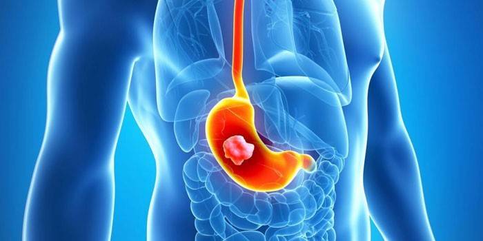 Ulcer stomacal