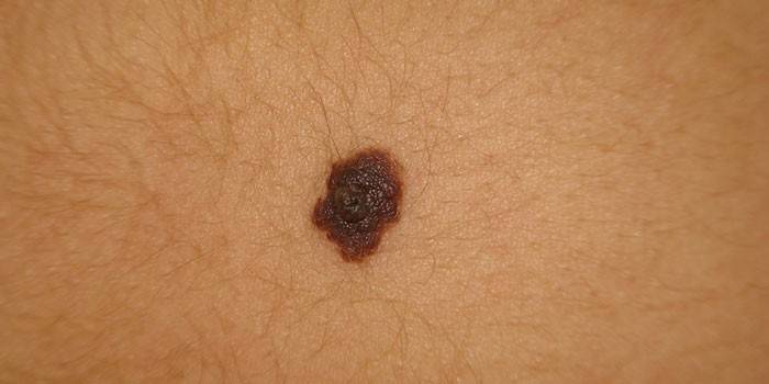 Pigmentuotas nevus ant odos