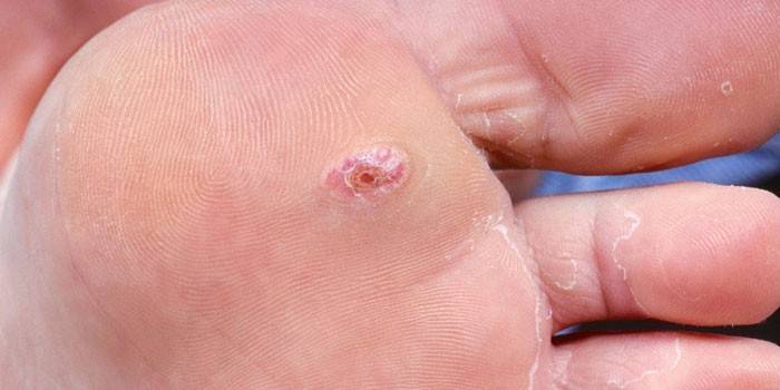 Πόδι Wart