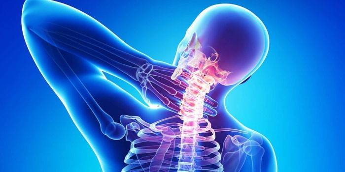 Nugaros osteochondrozė