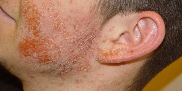 Streptoderma στο πρόσωπο ενός άνδρα
