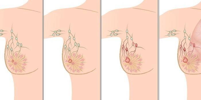 Fasi del cancro al seno