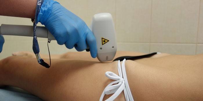 Depilazione laser della zona bikini