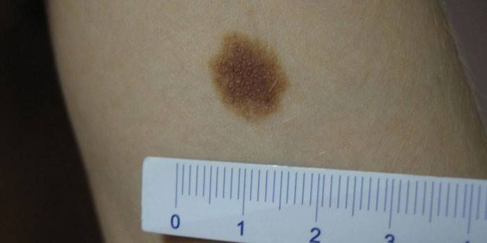 Displastinio nevus ant odos matmenys