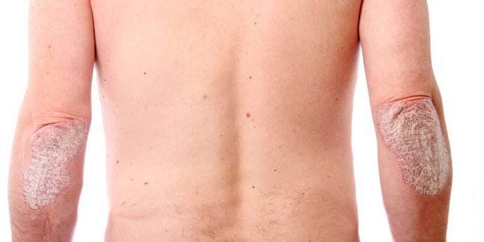Le psoriasis sur le corps