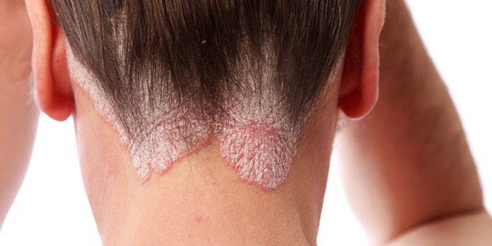 Galvas ādas psoriāze