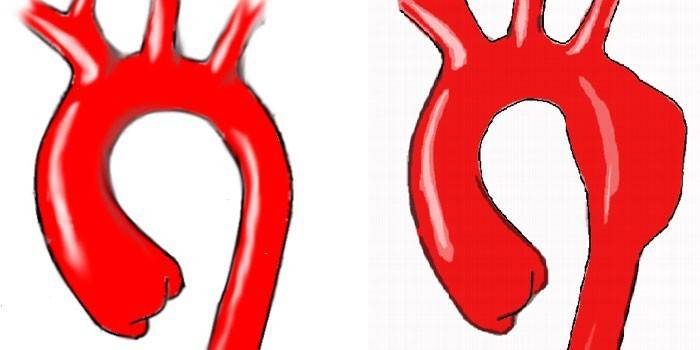 Động mạch chủ ngực khỏe mạnh và với những thay đổi bệnh lý
