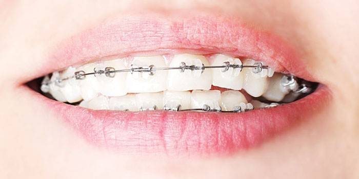 Bretelles en céramique sur les dents