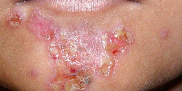 Foto streptoderma