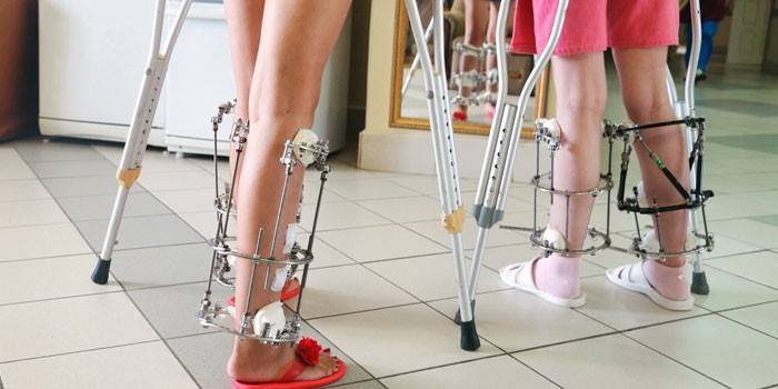 Femmes avec des béquilles et avec l’appareil d’Ilizarov aux jambes
