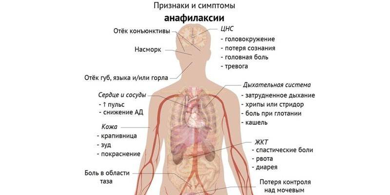 Anafilaksijos požymiai ir simptomai