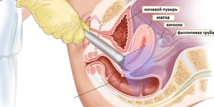 Schema di ultrasuoni transvaginali