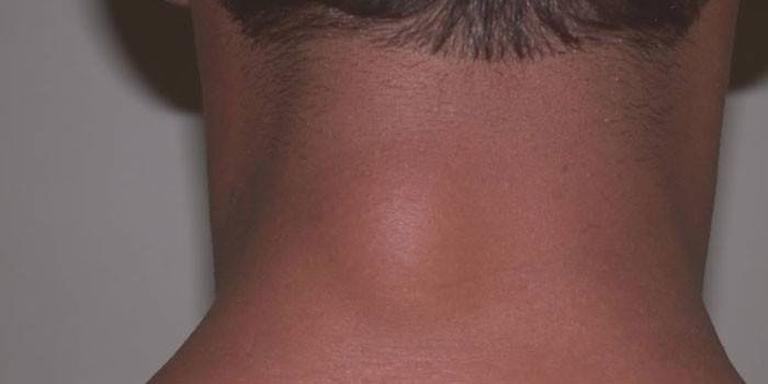 Zhirovik (lipoma) trên cổ