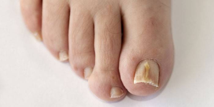 Champignon d'ongle d'orteil
