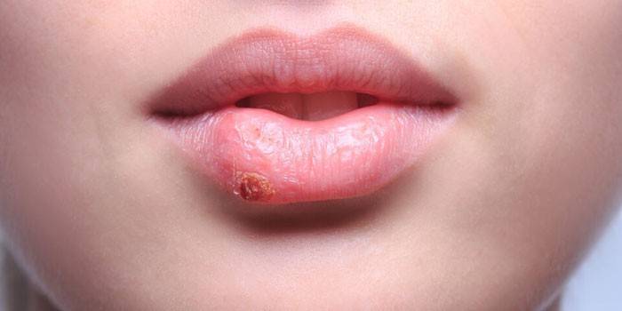 Herpes a lány ajkán