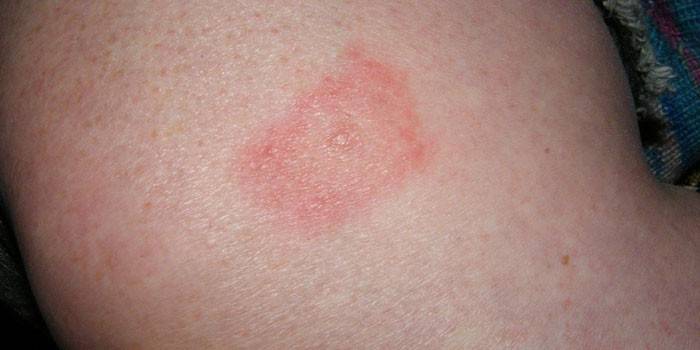 Borreliosis en piel humana.