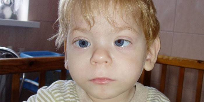 Un copil cu sindrom de alcool fetal