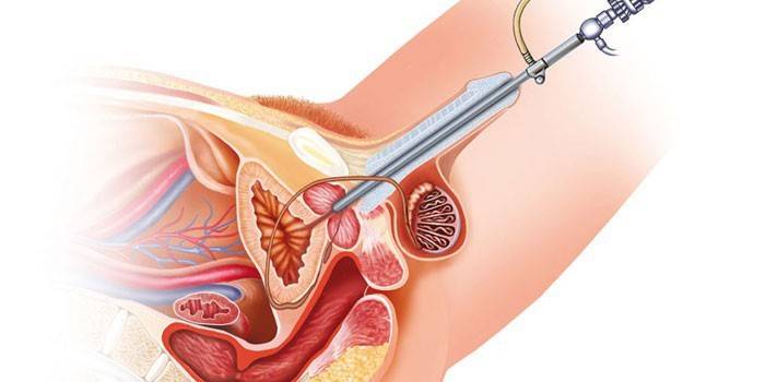 Đề án cắt bỏ tuyến tiền liệt của tuyến tiền liệt