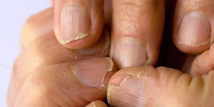 Fungo sulle unghie delle mani