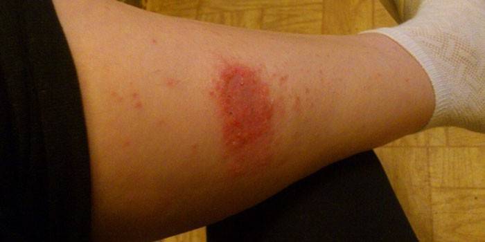 Egzematinis dermatitas ant moters kojos