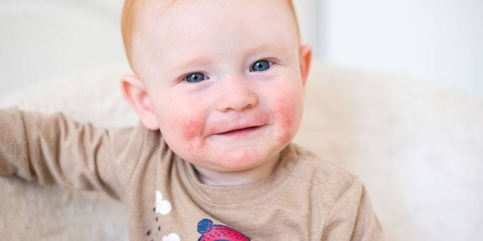 Dermatitis bei einem Kind