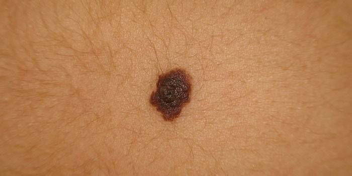 Melaniforminis nevus ant odos