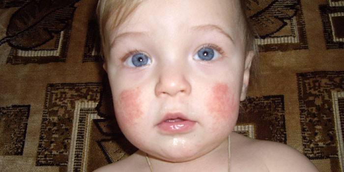 Dermatite atópica nas bochechas de uma criança