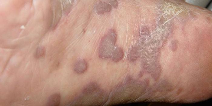 sarcoma ของ Kaposi อยู่บนเท้า