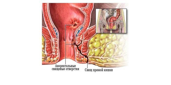 Fístula retal