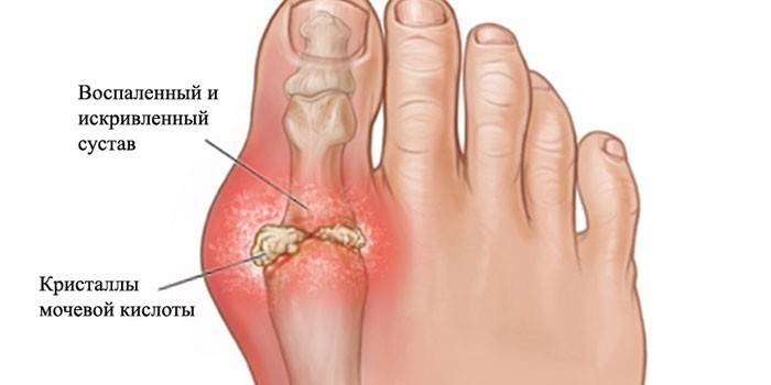 Artrosis de la articulación del dedo gordo
