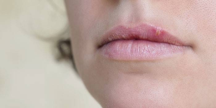 Dudaktaki herpes