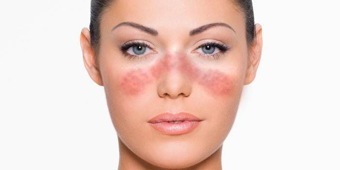 Cô gái bị bệnh lupus ban đỏ