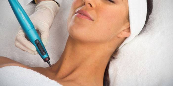 Ablation d'une tumeur au laser