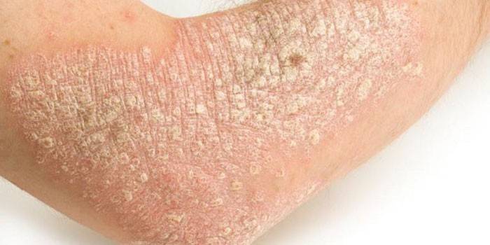 Psoriasi sulla pelle della mano