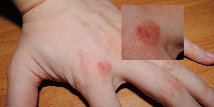 A fókuszos neurodermatitis megnyilvánulása a kar bőrén
