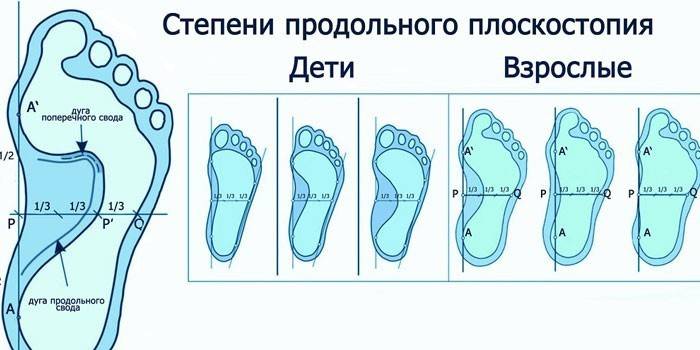 Степен уздужне равне ноге код деце и одраслих