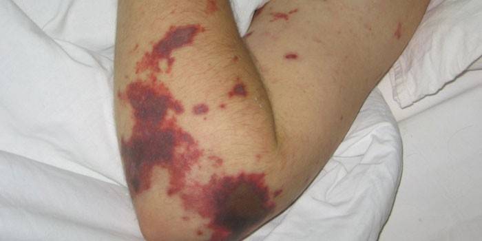 Erupción cutánea con infección meningocócica