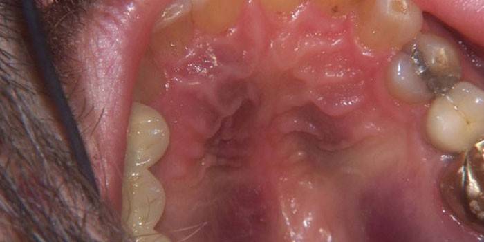 Sarcoma Kaposi บนท้องฟ้า