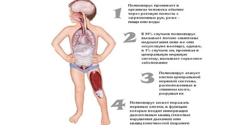Полио код деце