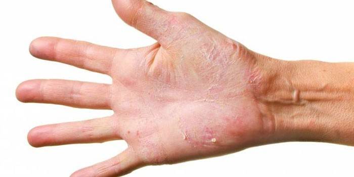 Dermatomikoosi käsivarressa