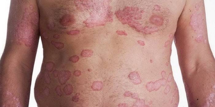 โล่ Psoriatic บนร่างกายของผู้ชายคนหนึ่ง