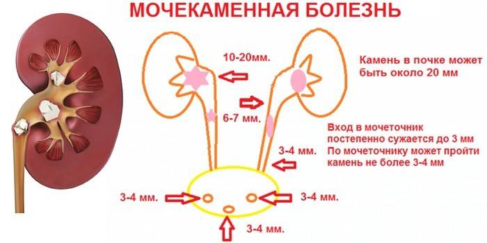 Urolitiazė