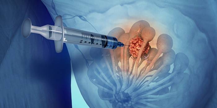 Puntura biopsia del seno