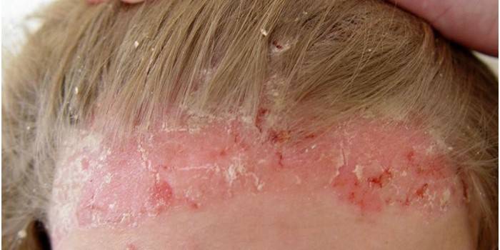 Seborrheic dermatīts