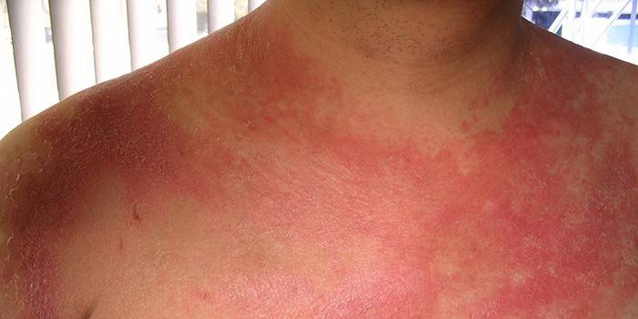 Manifestaciones de psoriasis en el cuerpo de un hombre.