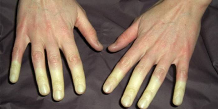 Zjawisko Raynauda