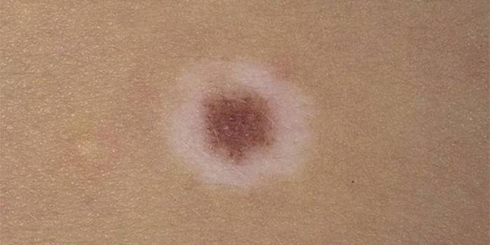 Ο Nevus του Setton στο δέρμα