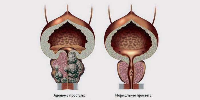 Esquema de una glándula prostática sana y con adenoma avanzado.