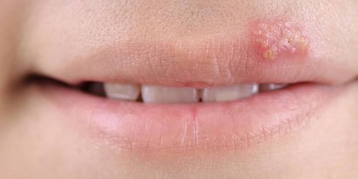 Herpes no lábio superior